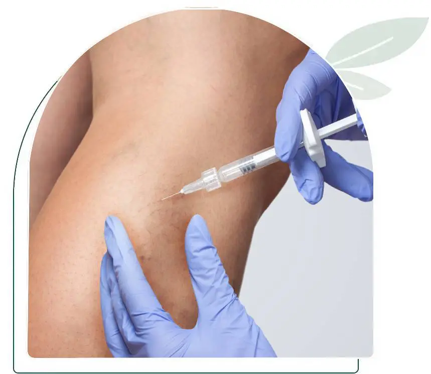 sclerotherapy