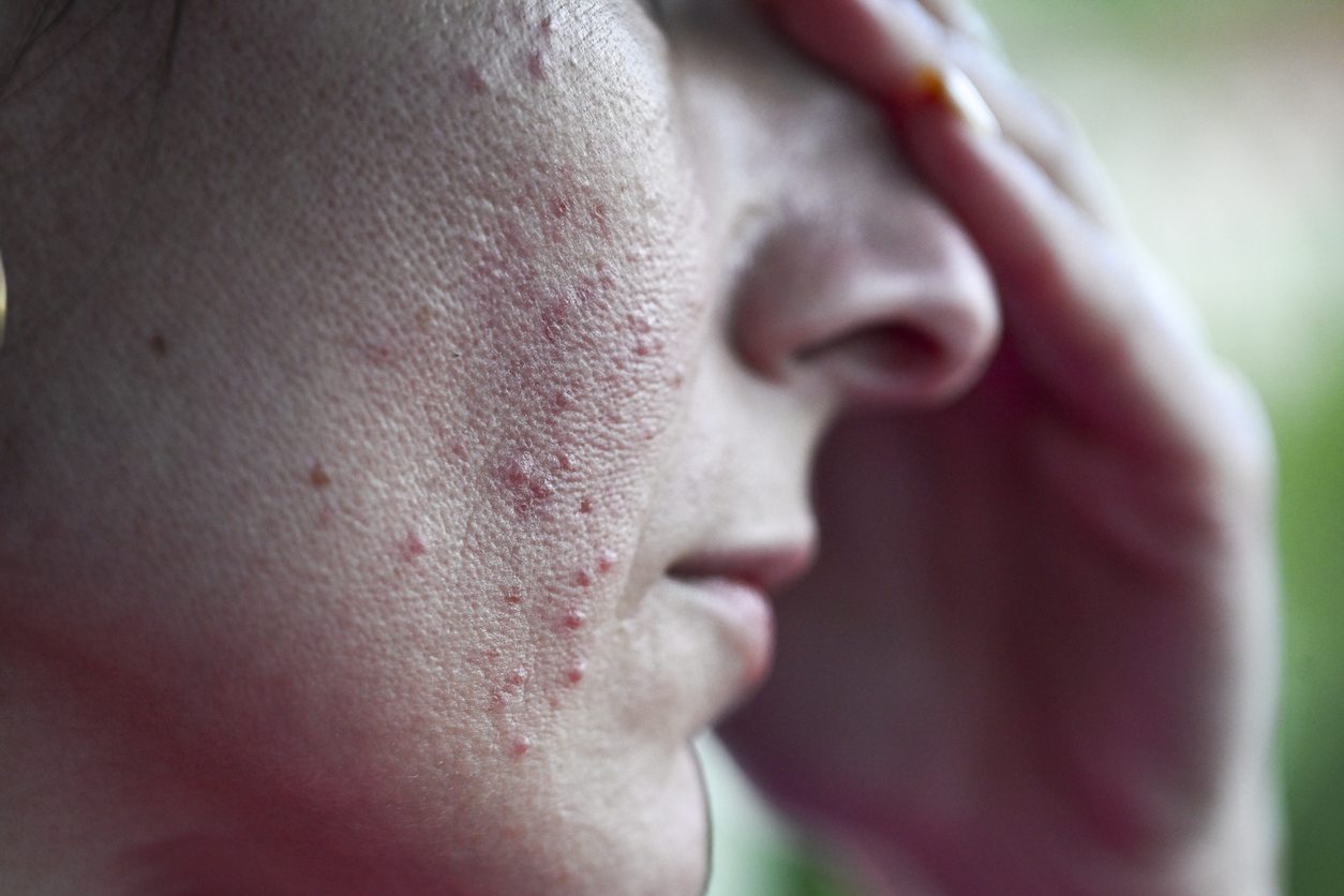 Close up shot of psoriasis rosacea - skin inflammation on a face of a young woman